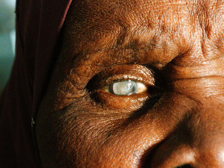 Cataracts